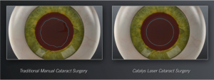 cataract surgery laser vs manual